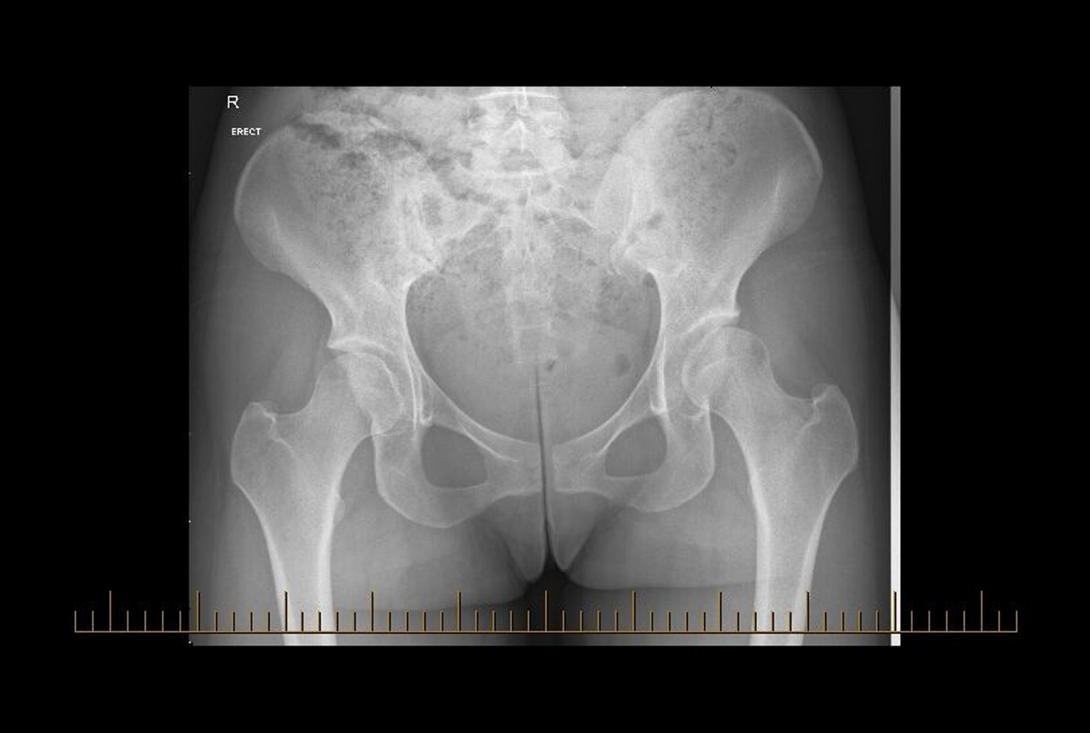 Adult Hip Dysplasia Surgery Treatment Sydney Dr Shidiak