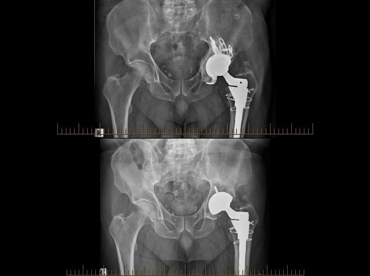hip replacement post-surgery & pre-surgery