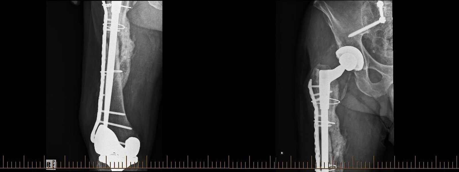 Revision Hip replacement