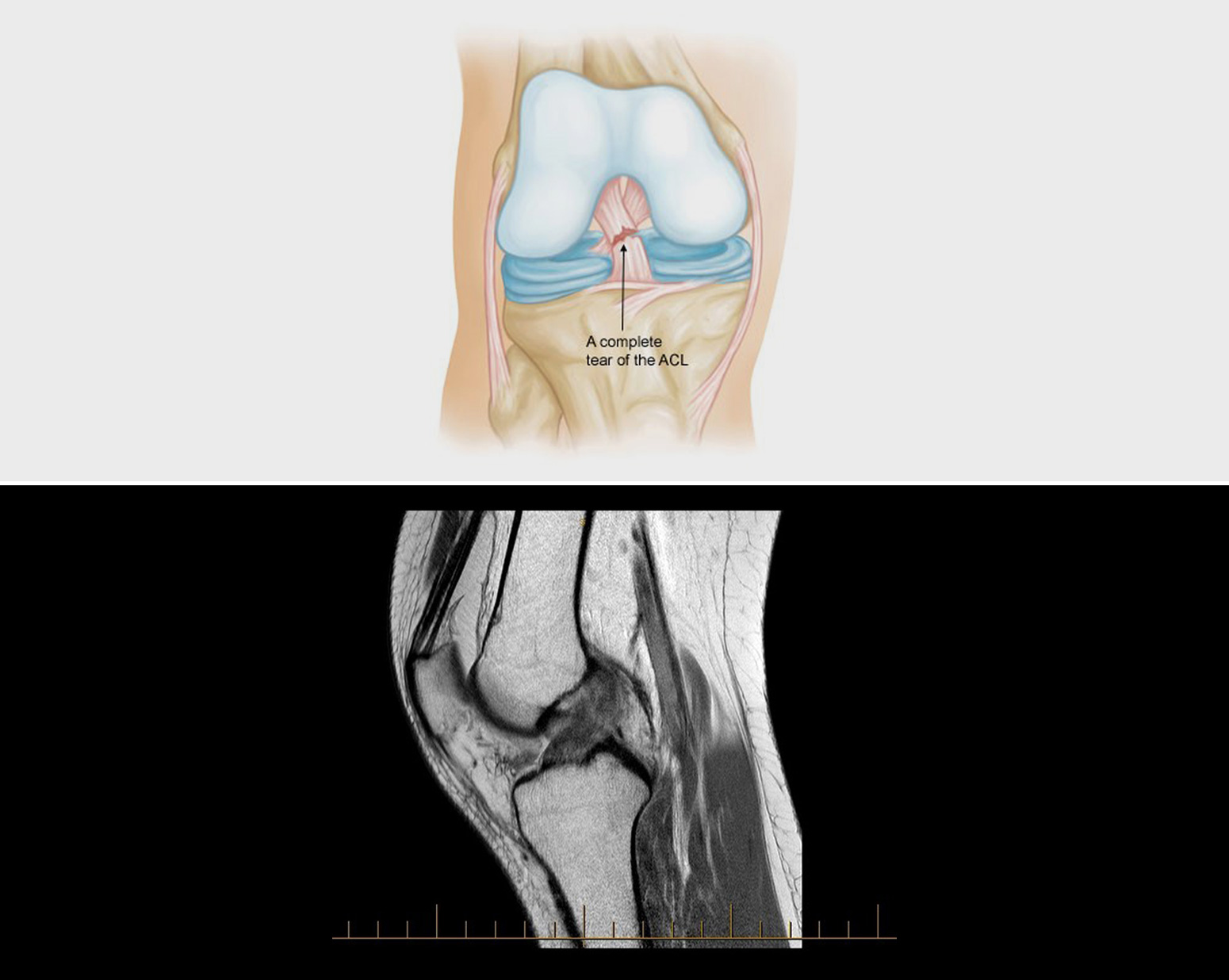 ACL Reconstruction