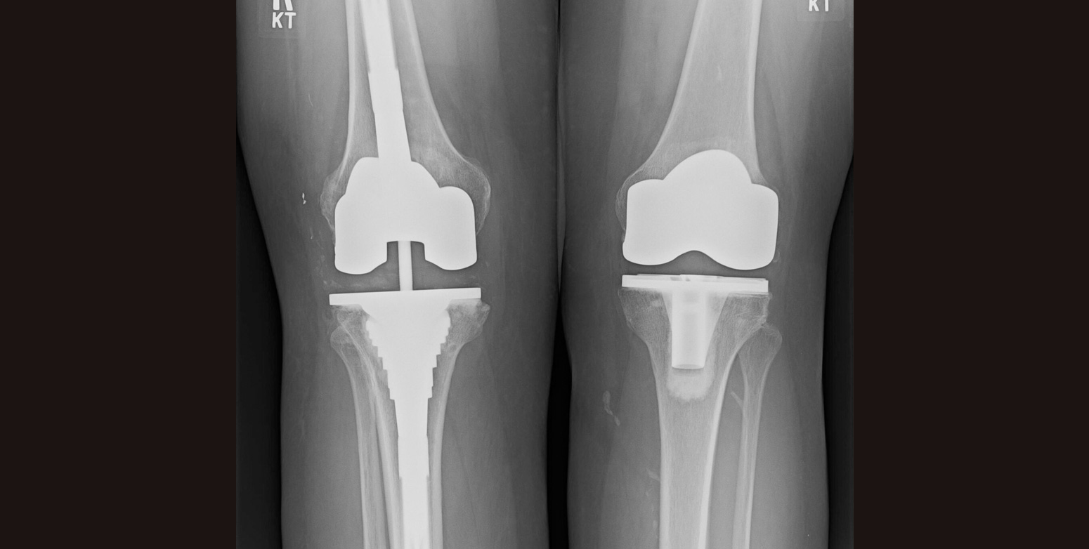 Revision Knee Replacement